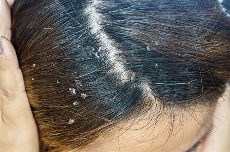 The 15 Causes of Dry Scalp (You Should Definitely Be Aware Of) - OptingHealth