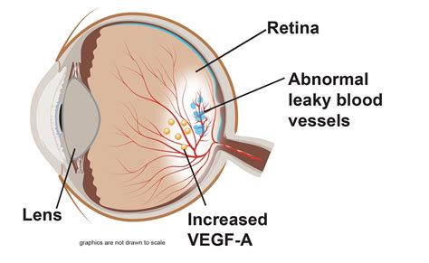 The Role of Fluid in Wet Age-related Macular Degeneration (wet AMD) - AMD