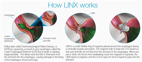 Linx Reflux Management System