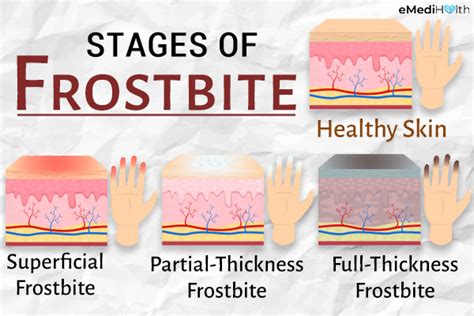 Frostbite Stages, Prevention and Treatment - eMediHealth