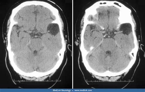 Arachnoid cyst | MedLink Neurology