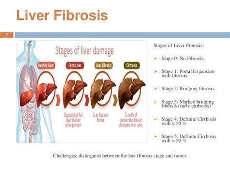 Intelligent computer aided diagnosis system for liver fibrosis