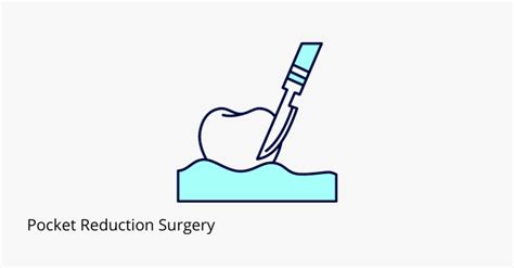 Pocket Reduction Surgery for Gum Disease Treatment - Share Dental Care