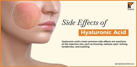 Hyaluronic Acid Powder | Its Uses, Benefits and Side Effects