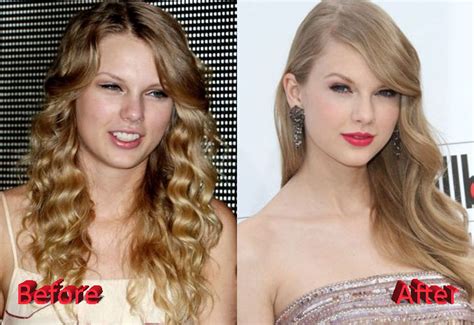 Taylor Swift Plastic Surgery Before and After