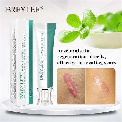 BREYLEE Acne Scar Removal Cream 30g Face Cream Skin Repair Skin Care Scar Acne Treatment Remove ...