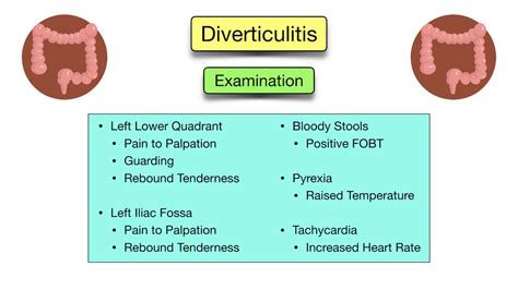 Diverticular Disease: Diverticulitis vs Diverticulosis - Symptoms, Diet ...