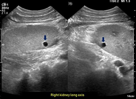 Ultrasound features of Kidney Cysts - Renal Fellow Network