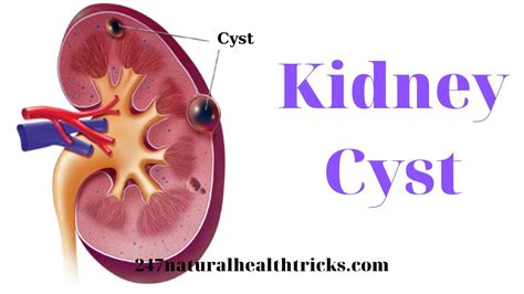 Kidney Cyst - Are cysts on kidneys life threatening? - Can kidney cysts just go away? | 247nht ...