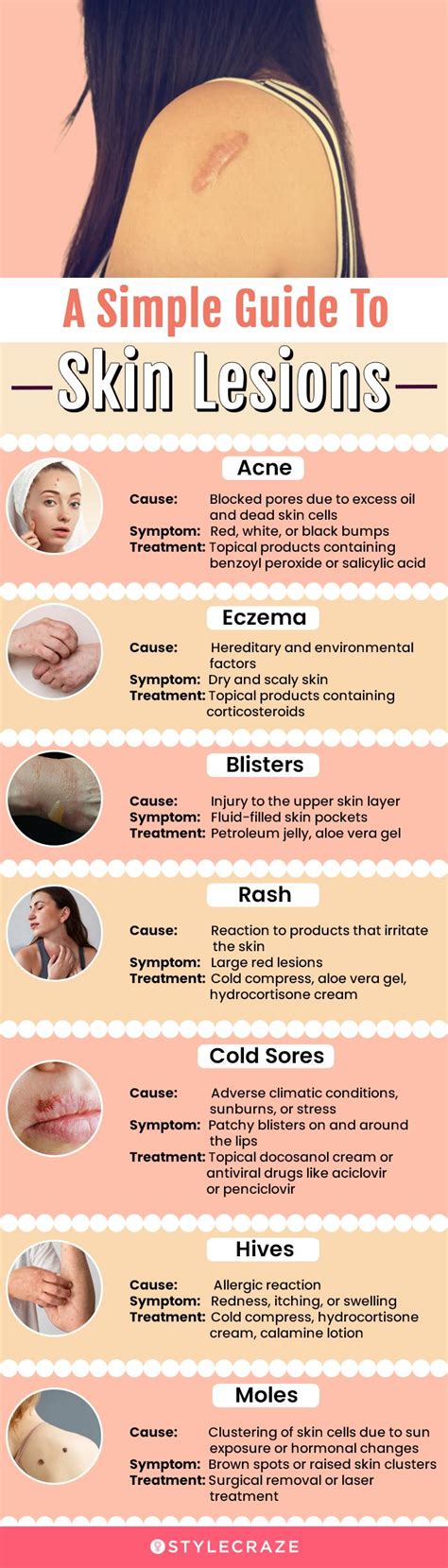 Skin Lesions: Types With Chart, Pictures, Causes, Treatment, 56% OFF