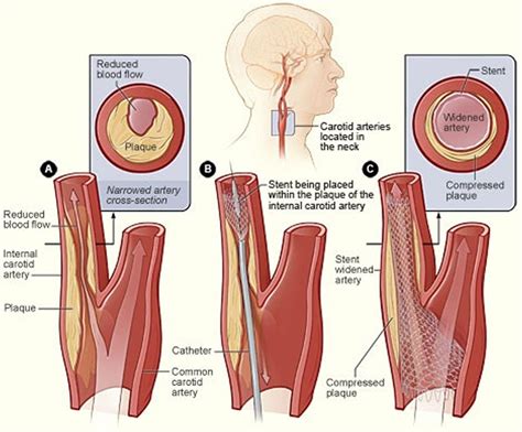 Carotid artery disease - Stenosis, Carotid Artery Dissection