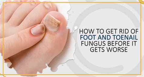 How to Get Rid of Foot and Toenail Fungus Before it Gets Worse