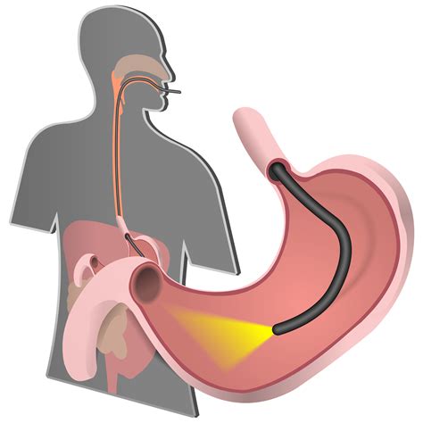 Upper GI Endoscopy – Adirondack Gastrointestinal & Colorectal Surgery