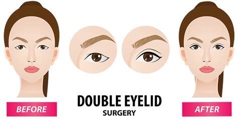 Double Eyelid Surgery – i-Aesthetic