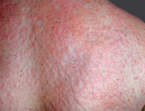 Breaking Out In Itchy Bumps : Why A Skin Rash May Be A Coronavirus Symptom According To Doctors ...