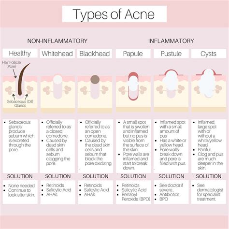 Types of Acne Diagram - Etsy