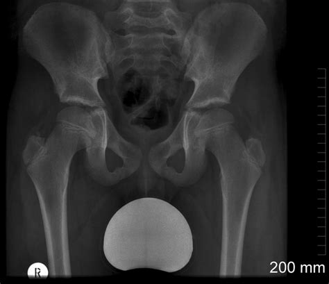 Male Vs Female Pelvis X Ray