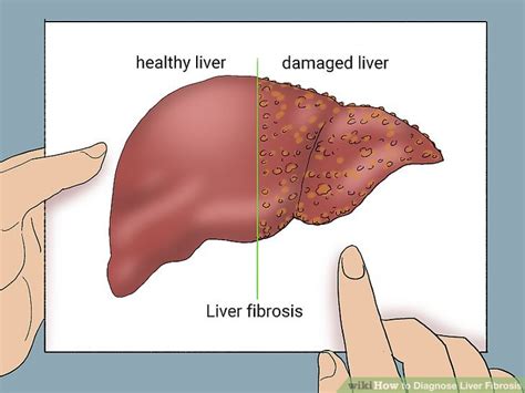 How to Diagnose Liver Fibrosis