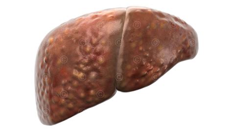 Image of hepatic fibrosis – Stage F2 / F3 | Pharmact Group