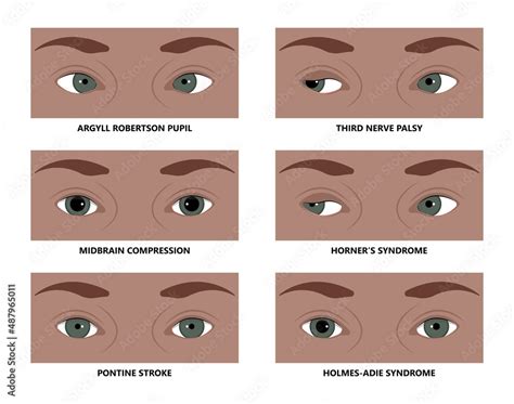 miosis eye pupil size iris retina brain Horner miotic muscle dilated ocular injury ptosis reflex ...