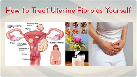 How to Treat Uterine Fibroids Yourself - YouTube