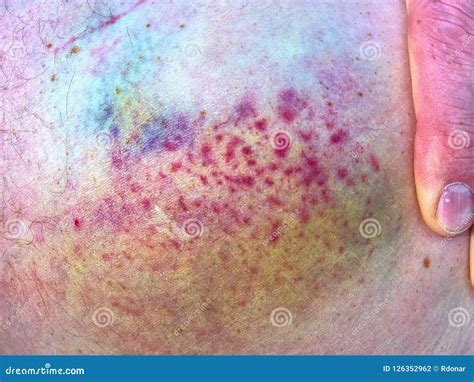 Purple Bruise on the Skin, Close Up View. Colorful Hematoma. Stock ...