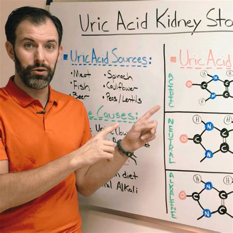 Uric Acid Kidney Stones Stopped For Good! | Stone Relief