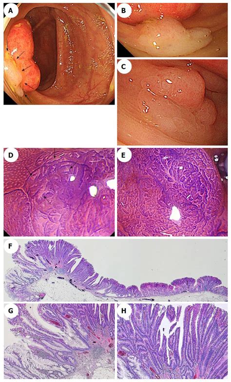 Sessile Serrated Polyp