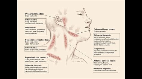 lymphadenopathy by Prof Dr Galal Abouelnagah - YouTube