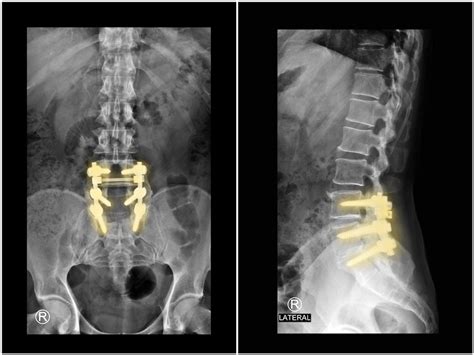 Laminectomy - Dr. Nael Shanti