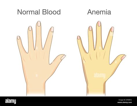 The difference of Anemia people skin and normal people Stock Vector Image & Art - Alamy