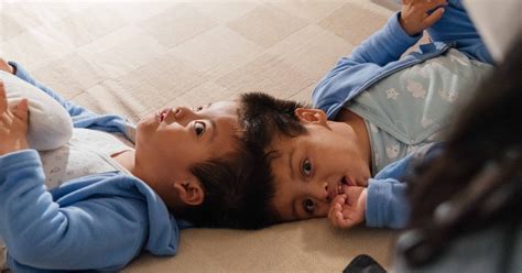 Dayton Children’s releases documentary following the unprecedented separation surgeries of ...