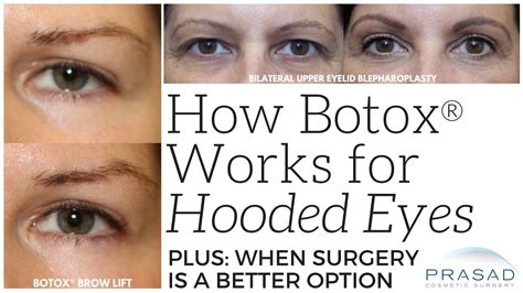 Botox Eye Brow Lift Before And After, Eyebrow Lift Using Botox » Eyelid Surgery: Cost, Photos ...