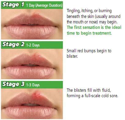 Beginning Of Cold Sore Stages