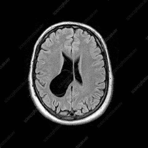 MRI of Intraventricular Arachnoid Cyst - Stock Image - C004/7473 ...