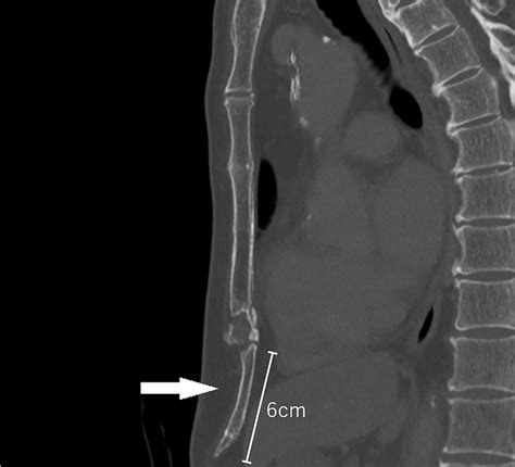 Large xiphoid process (white arrow) seen on CT | Download Scientific Diagram