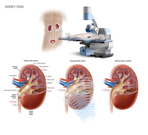 How are Kidney Stones Treated? - Urology Care Foundation