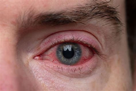 Causes of Red Rings Around the Eyes - Eye Conditions - The Eye News