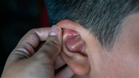 Ear Eczema: Symptoms, Causes, and Treatments