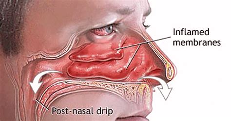 17 Home Remedies for Blocked Nose or Stuffy Nose - The Discover Reality