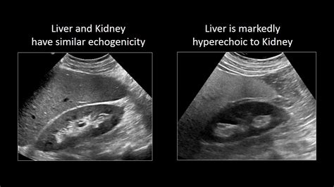 Normal Vs Fatty Liver Ultrasound