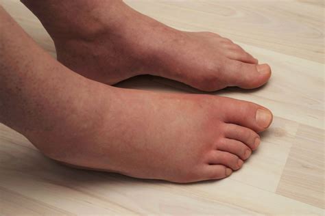 What Causes Swollen Feet and Ankles? – My FootDr