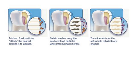 Can You Remineralize Tooth Enamel? | Dentist Lady's Island | Beaufort SC