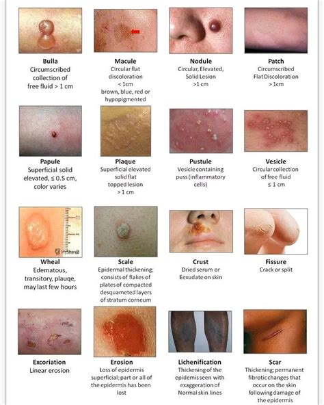 an image of different types of acne on the face and neck, with text ...