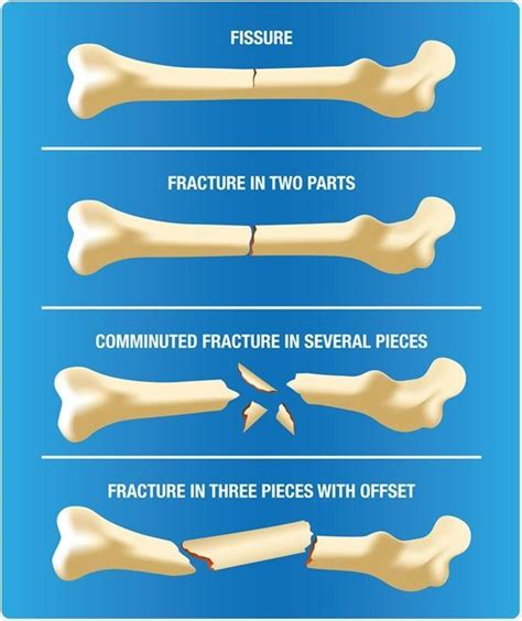 Fracture Recognition and Treatment Options: Orthopedic Center for ...