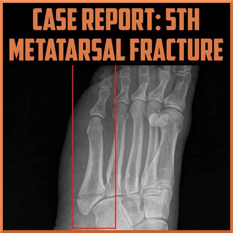 Case Report: fifth Metatarsal Fracture - My Blog