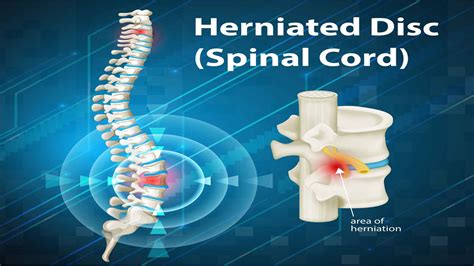 What Are Some Common Herniated Disc Symptoms? - Henry Chiropractic