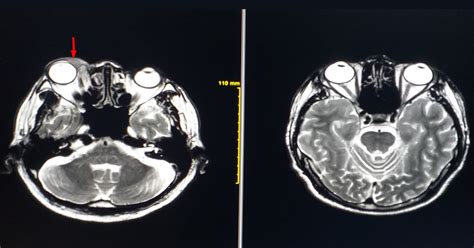 Best Optic Nerve Tumor Surgeries Drs & Hospitals in India