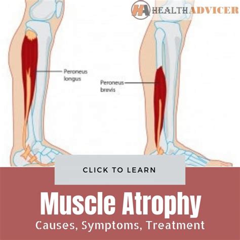 Muscle Atrophy: Causes, Symptoms, Diagnosis And Treatment