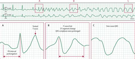 Sine Wave Hyperkalemia Ecg Changes